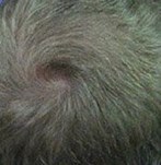 Nach der Haartherapie mit PRP