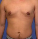 After Male Breast Reduction