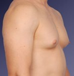 Before Male Breast Reduction 