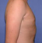 Korrektur Der Mannlichen Brustwarzen Informationen Und Kosten