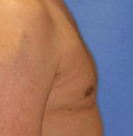 Korrektur Der Mannlichen Brustwarzen Informationen Und Kosten