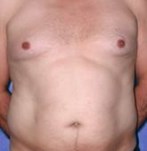 Before Male Liposuction