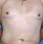 After Male Liposuction