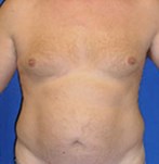 Voor en na abdominale liposuctie bij mannen