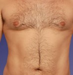 Après liposculpture pour homme