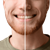 White teeth: dental bleaching