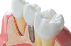 Implants