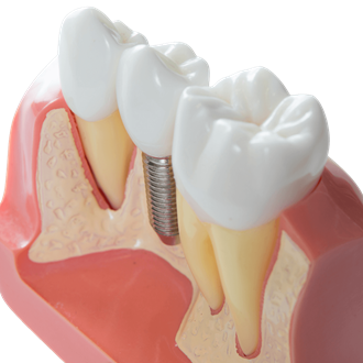Dental Implants Photos: Dental Implants