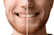 Tanden witmaken / bleken: dental bleaching