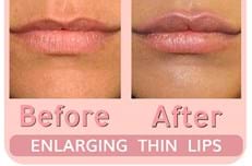 Photos for Lip Augmentation with Fillers