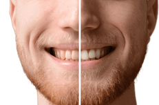 Dents blanches : blanchiment des dents