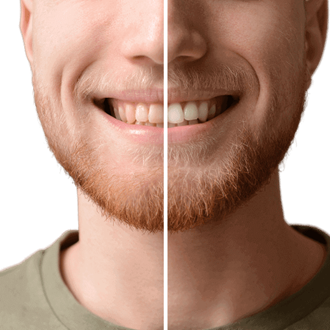 Photos avant / après de dents blanchies: Blanchiment des dents