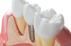 Implants