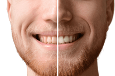 Weiße Zähne: Zahnaufhellung