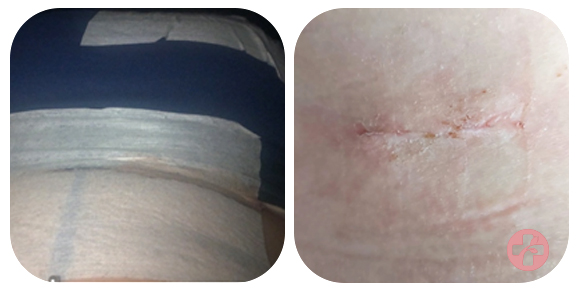 Verband en litteken