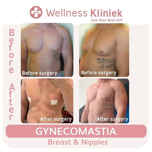 Gynaecomastia