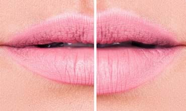 4 choses à savoir sur les produits de remplissage des lèvres 