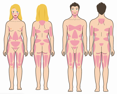 liposuction different body parts wellness kliniek