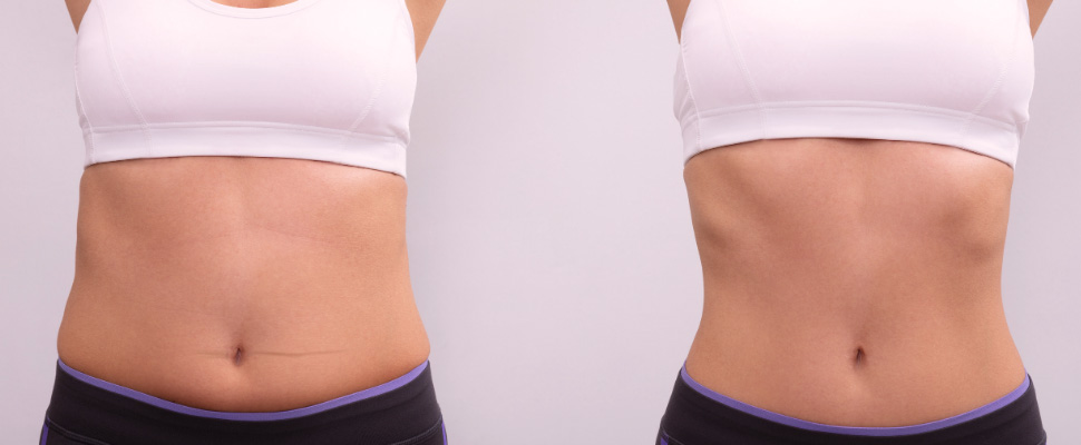 Welche Körperteile können mit einer Liposuktion behandelt werden?