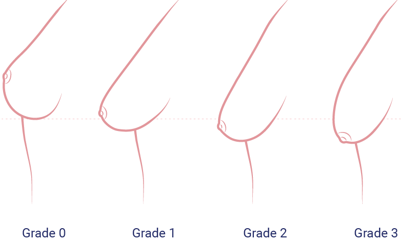Gradierung der Brüste für eine Brustvergrößerung