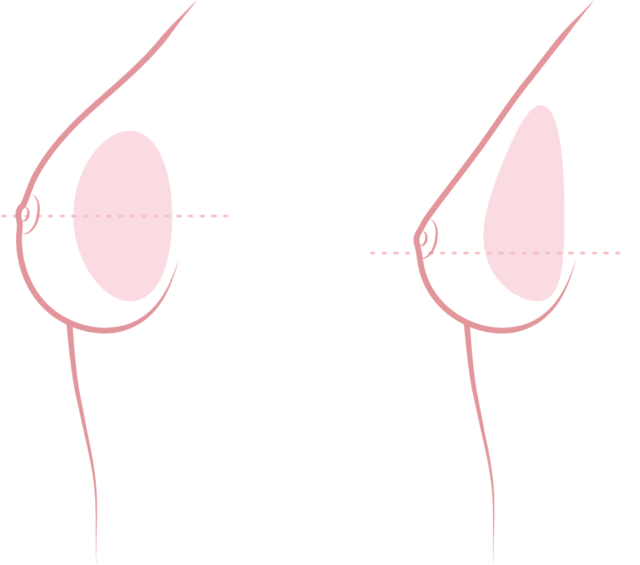 Zwaartekracht van een druppelvormig borstimplantaat