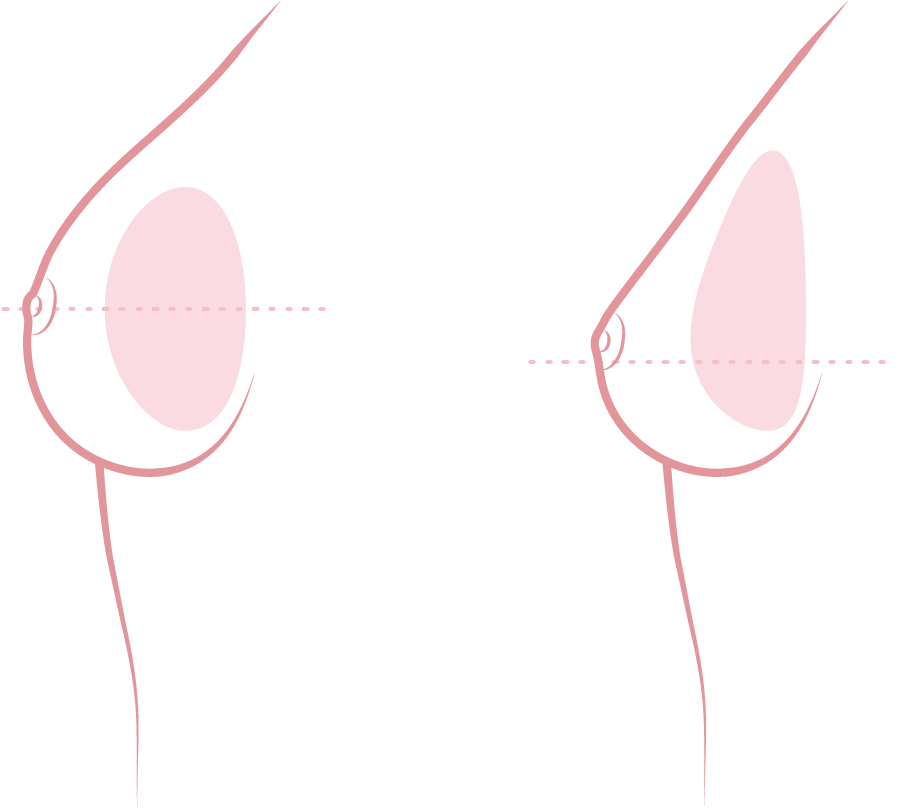 drop-shaped implant gravity