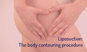 Facts and Myths about Liposuction