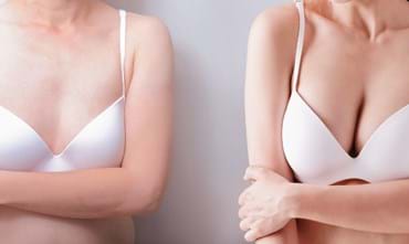 What does breast enlargement with your own fat involve?
