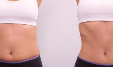 Which body parts can be treated with liposuction?