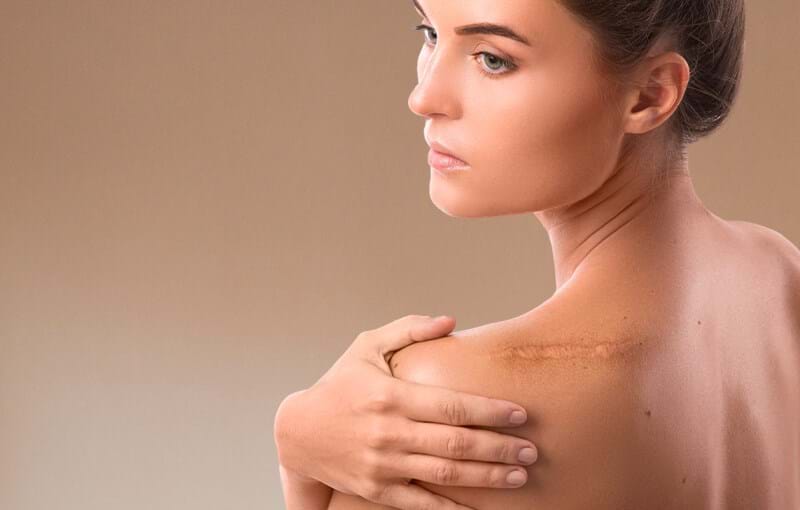 Scarrection Scar correction | scar reduction - Wellness Kliniek