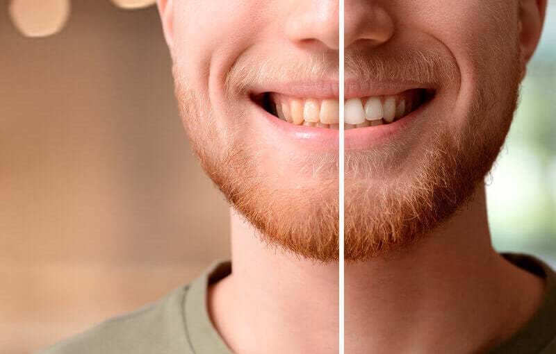 White teeth: dental bleaching
