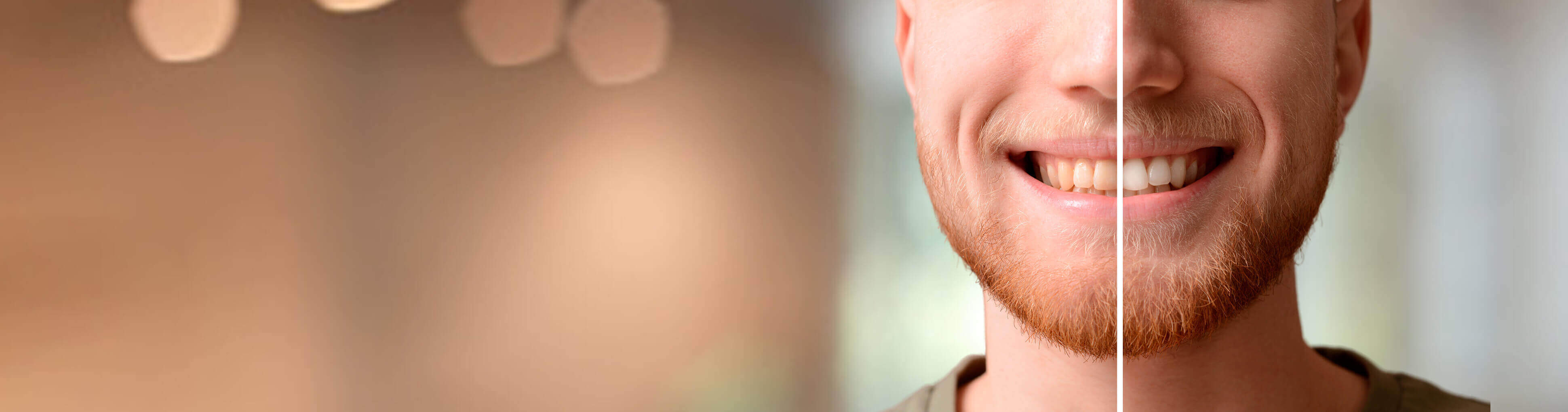 White teeth: dental bleaching