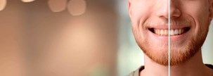 White teeth: dental bleaching