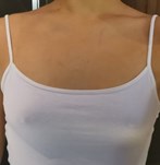 Breast augmentation operation with size 340cc XP implants