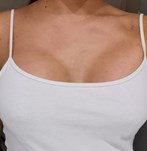 Brustvergrößerung mit 340cc XP-Implantaten