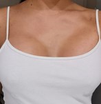 Breast augmentation operation with size 340cc XP implants