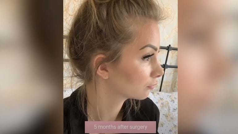 Nose correction - real case Wellness Kliniek