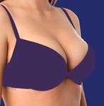 photos of breast implants size 300cc results