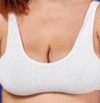 Breast before a reduction procedure