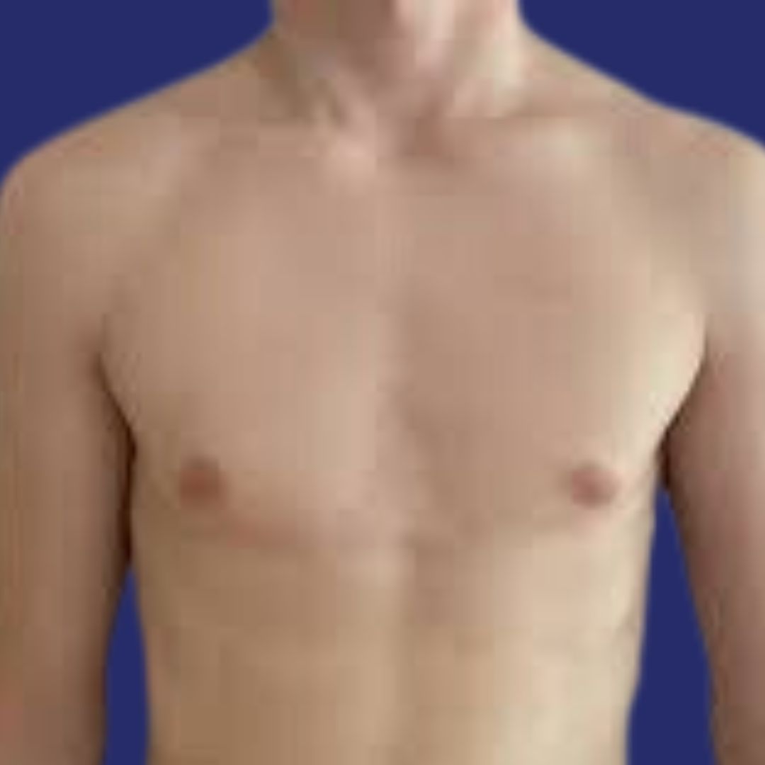 Avant augmentation mammaire transgenre 