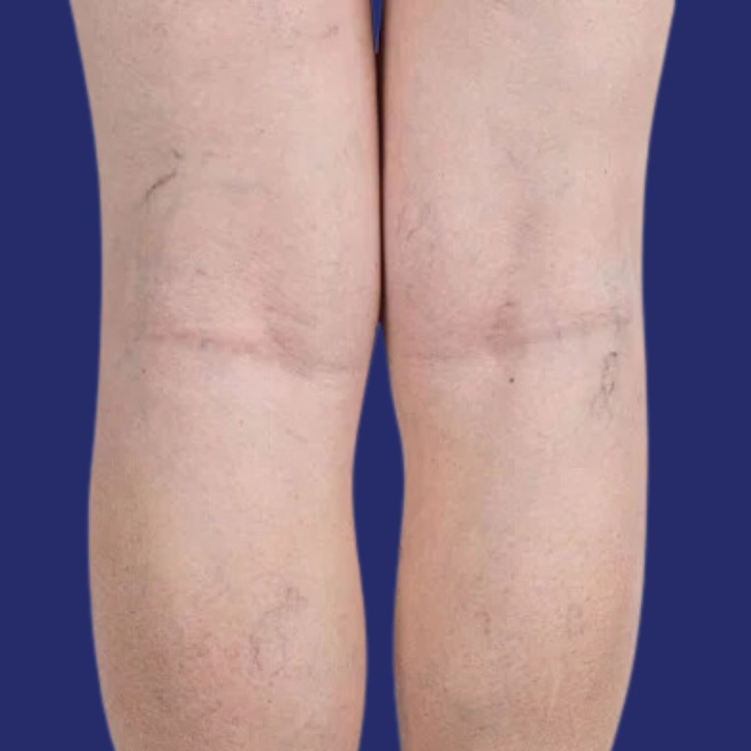 Image de veines saillantes sur les jambes avant traitement vasculaire