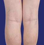 Image of prominent veins on the legs before vascular treatment