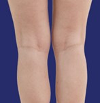 Result of smoother legs without visible veins after vascular treatment