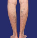 Photograph of varicose veins before the removal procedure