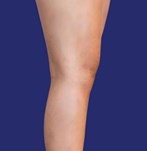 Photograph of visibly improved legs after vein removal treatment