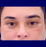 Nahaufnahme eines hängenden Augenbrauen vor dem Augenbrauenlifting-Verfahren