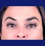 Close-up image of lifted eyebrows post brow lift surgery