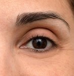 Bild, das hängende Augenbrauenlinie vor der Augenbrauenlift-Behandlung zeigt