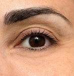 Fotografie, die die angehobene Augenbrauenlinie nach dem Augenbrauenlift-Verfahren zeigt