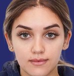 Image showcasing balanced and elevated eyebrows post brow lift procedure